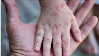 الصحة العالمية.. جدري القردة لن يتحول لوباء